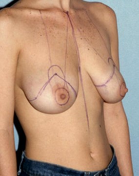breast-lift1-before.jpg