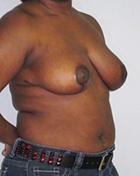 breast-reduction-12b.jpg
