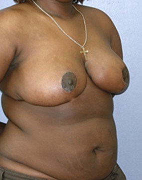 breast-reduction-13b.jpg