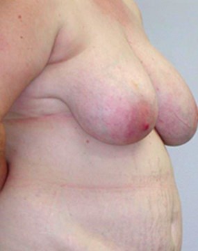breast-reduction-19a.jpg