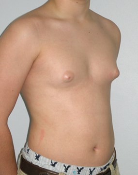 Gynecomastia-case-3-before.jpg