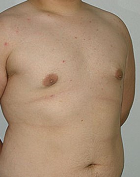 Male-breast-enlargement-post.jpg
