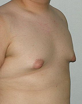 Male-breast-enlargement-pre.jpg