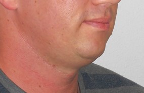 Case 2 chin contouring before.JPG