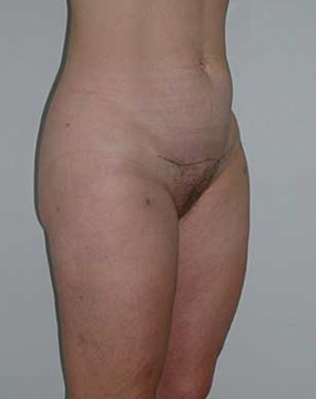 Body-contouring-4-po-obl.jpg