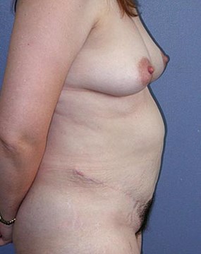 Case-11-Giant-hernia-post.jpg