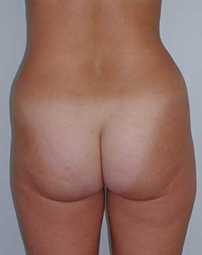 Body-contouring-1-pre-back.jpg