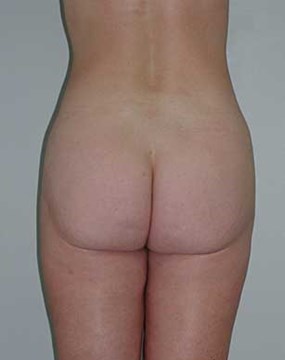 Body-contouring-4-po.jpg