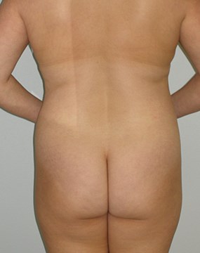 liposculpture-case8-before.jpg