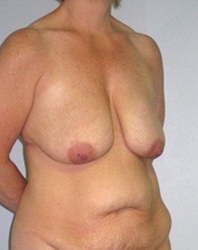 breast-lift9-before.jpg