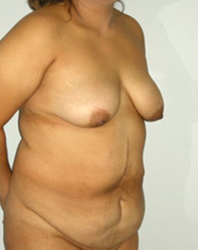 breast-lift11-before.jpg