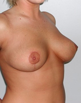 breast-reduction-8b.jpg