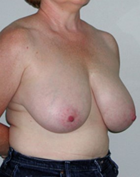 breast-reduction-16a.jpg