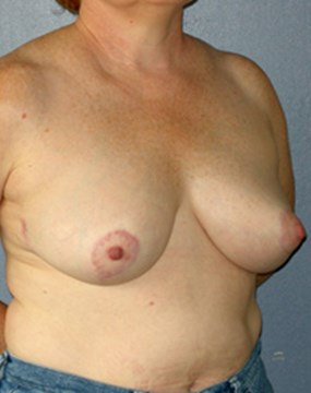 breast-reduction-16b.jpg