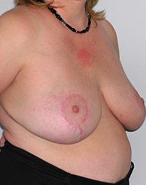 breast-reduction-18b.jpg