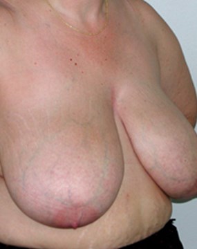 breast-reduction-20a.jpg